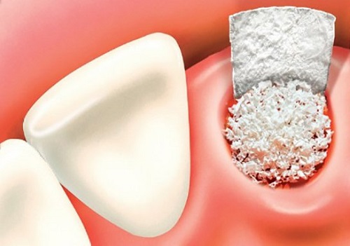 Viêm ổ răng khôn - Nguyên nhân - Biểu hiện - Xử lý 3