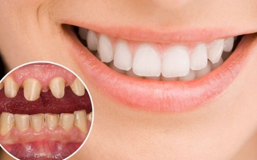 Bọc răng sứ cả hàm - Cần lưu ý điều gì? 1
