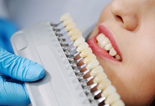 Bọc răng sứ cả hàm - Cần lưu ý điều gì? 3