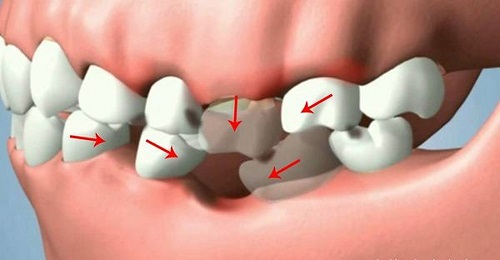 Trồng răng có chân răng - Giải pháp khắc phục hiệu quả 1