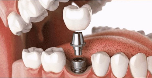 Trồng răng có chân răng - Giải pháp khắc phục hiệu quả 2