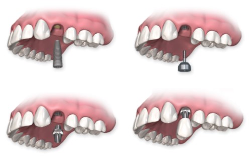 Trồng răng có chân răng - Giải pháp khắc phục hiệu quả 3