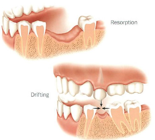 Trồng răng cối - Khắc phục các biến chứng trên răng 1