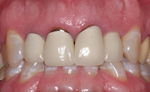 Răng sứ bị hở - Nguyên nhân và biến chứng bạn nên biết 1
