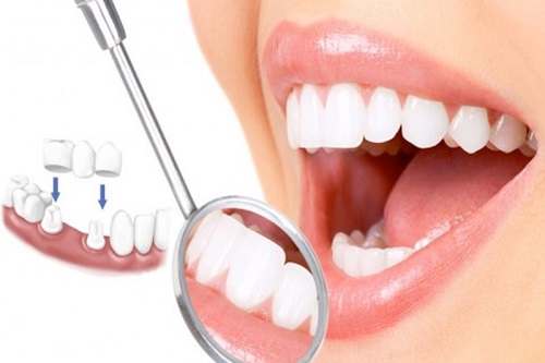 Răng sứ bị hở - Nguyên nhân và biến chứng bạn nên biết 3