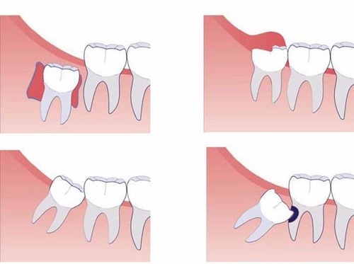Sưng lợi ở răng khôn - Cách chữa trị hiệu quả 1