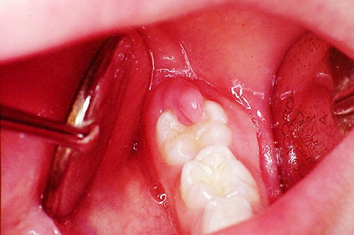 Sưng lợi ở răng khôn - Cách chữa trị hiệu quả 2