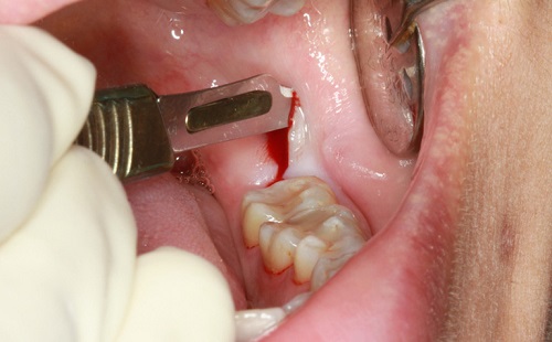 Sưng lợi ở răng khôn - Cách chữa trị hiệu quả 3