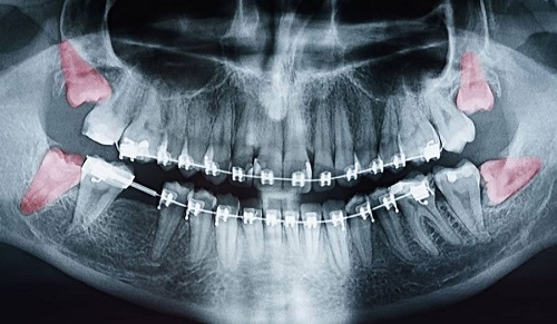 Nhổ 2 răng khôn hàm dưới cần lưu ý điều gì? 2