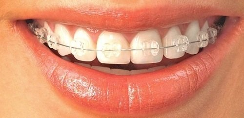 Niềng răng xong có nên tẩy trắng răng? Tìm hiểu 1