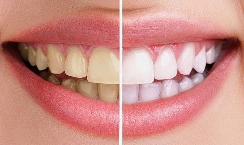 Niềng răng xong có nên tẩy trắng răng? Tìm hiểu 2