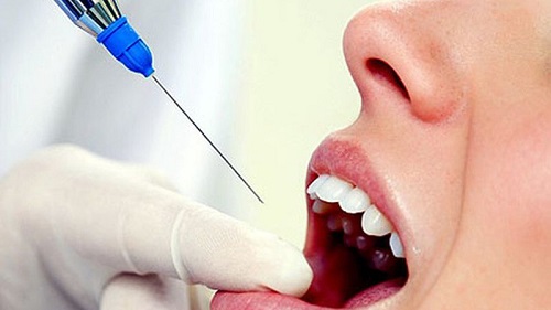 Cắm vít niềng răng có đau không? Bác sĩ trả lời chi tiết 2