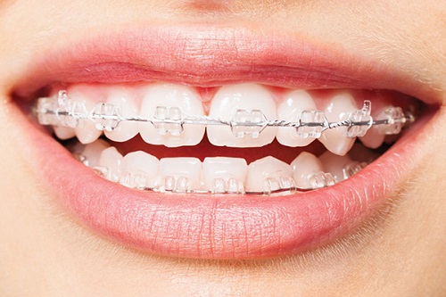 Niềng răng xong bị móm là do kỹ thuật hay cơ địa? 3