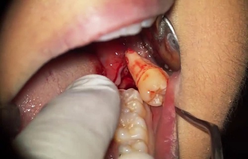 Răng khôn bị nhiễm trùng - Nguyên nhân - Biến chứng 1