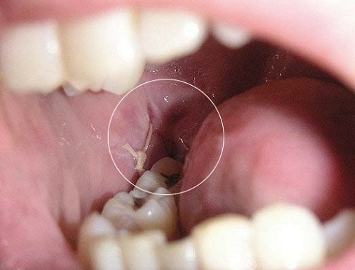 Răng khôn bị nhiễm trùng - Nguyên nhân - Biến chứng 3