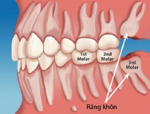 Răng khôn có bắt buộc phải nhổ không? 2