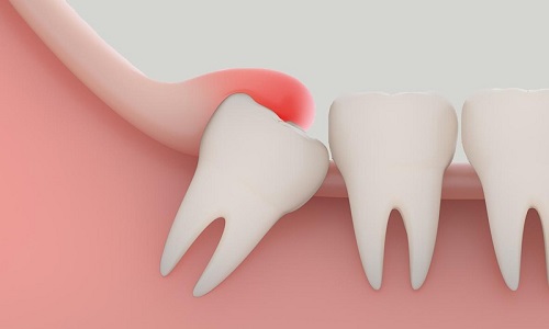 Răng khôn có bắt buộc phải nhổ không? 3