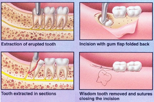 Răng khôn làm sâu răng số 7 - Cách xử lý cho bạn 2