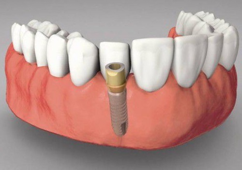 Trồng răng giả có đau không? Các thông tin cần lưu ý 2