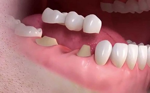 Trồng răng giả có đau không? Các thông tin cần lưu ý 3
