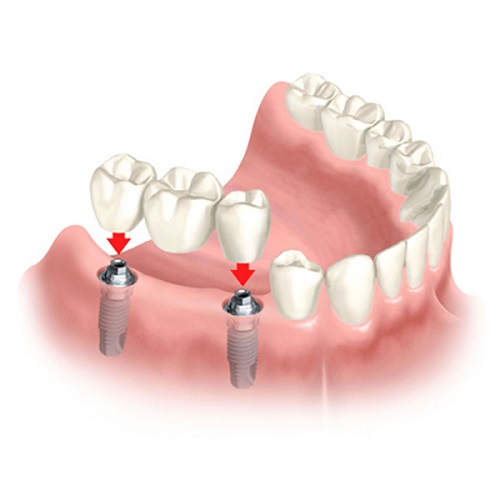 Trồng răng giả có lâu không? Lưu ý điều gì? 2