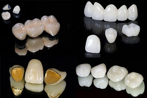 Kinh nghiệm làm răng implant bạn nên biết 3