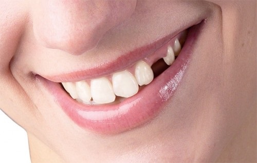 Trồng răng sứ có tốt không? Tham khảo răng sứ 1