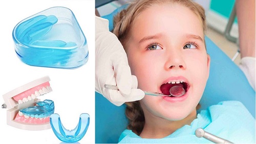 Dụng cụ niềng răng tại nhà 3 giai đoạn hiệu quả 2