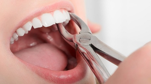 Răng khôn hàm trên bị sâu phải làm sao? 1