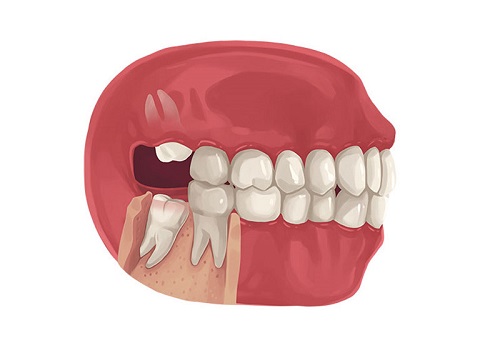Răng khôn hàm trên bị vỡ - Cách khắc phục 2