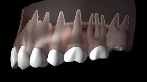 Răng khôn hàm trên bị vỡ - Cách khắc phục 1