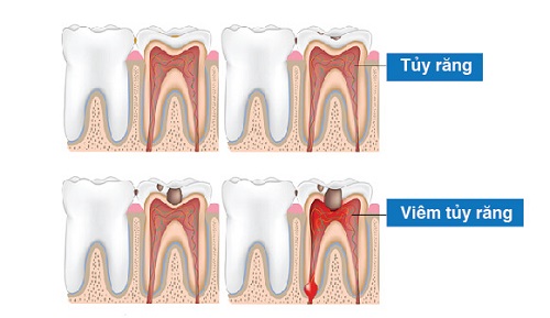 Cách điều trị tủy răng sữa cho trẻ em - Những điều cần lưu ý 3