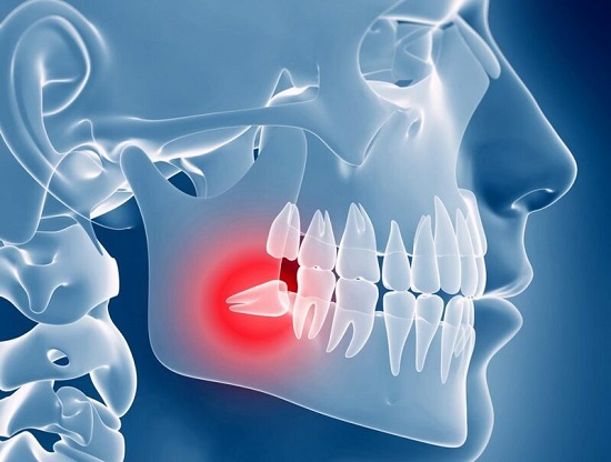 Răng khôn mọc ngược nguy hiểm như thế nào? 2