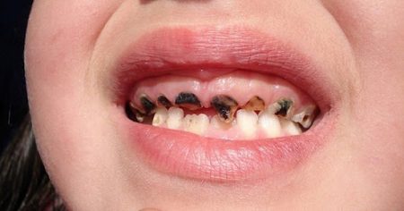 Thực phẩm gây sâu răng ở trẻ em phụ huynh nên biết