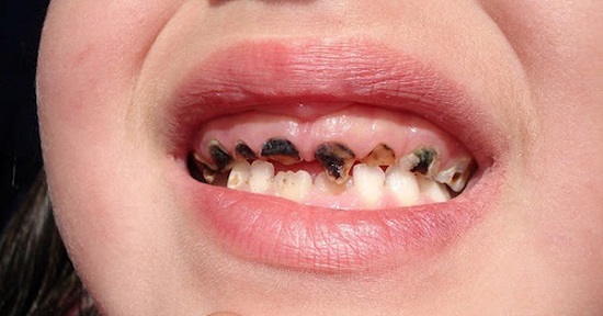 Thực phẩm gây sâu răng ở trẻ em phụ huynh nên biết 1
